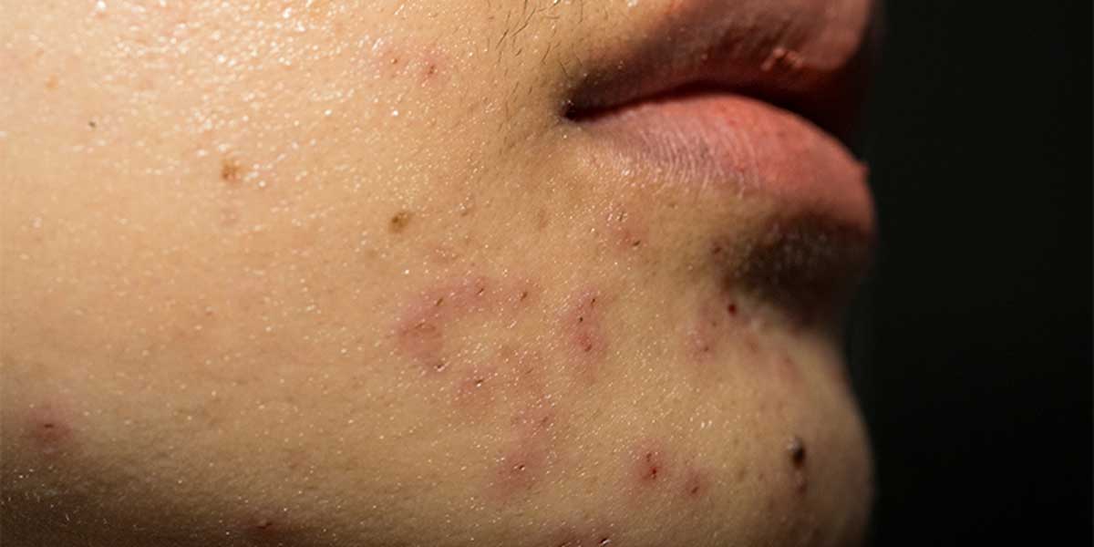 acne happens with PCOS patients