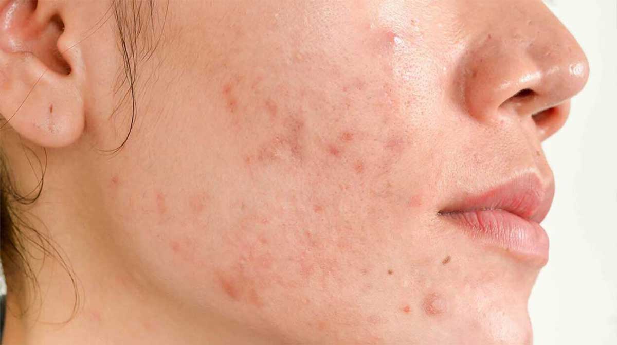 Hormonal Imbalance Result In Acne