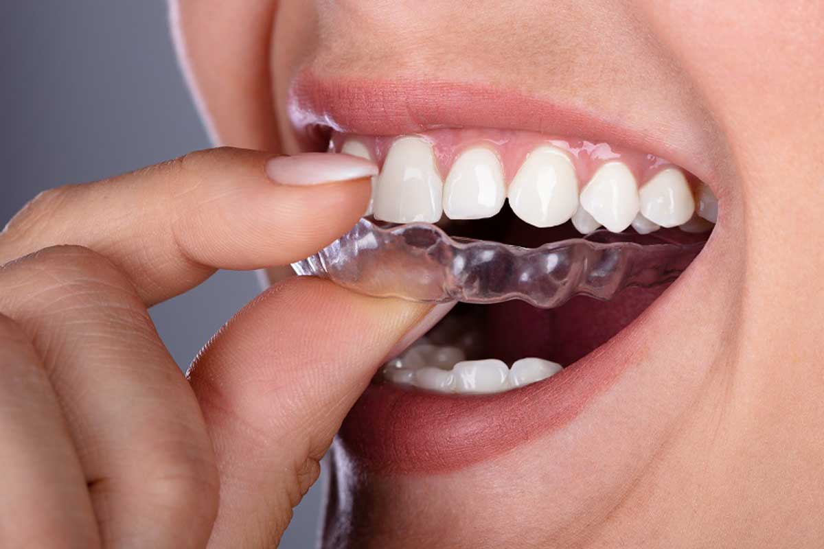 How Invisible Aligners Work