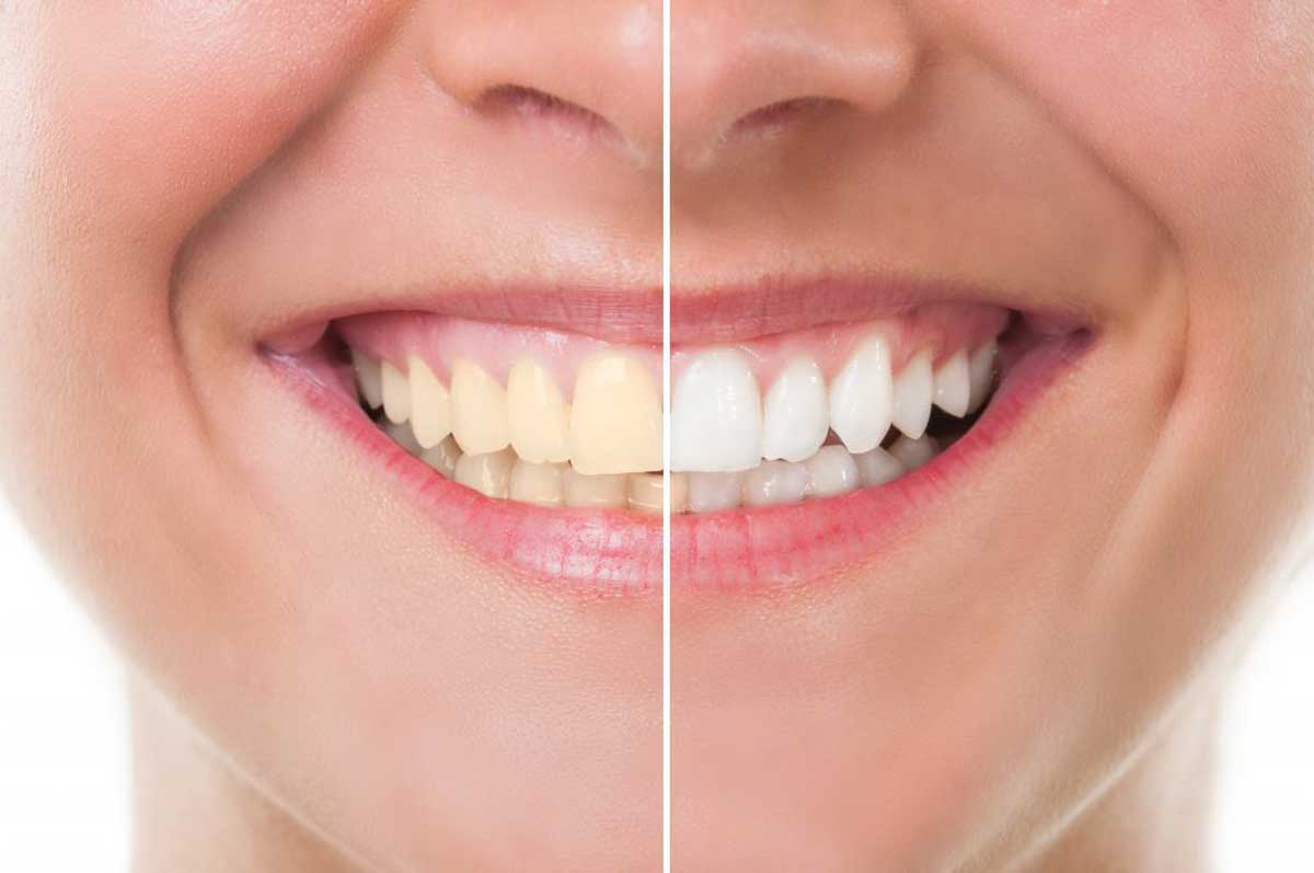 Teeth whitening options